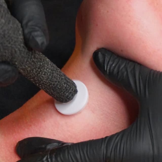MD Microchanelling X Stem Cells at SILK SKIN SPA + AESTHETICS in Salinas, CA